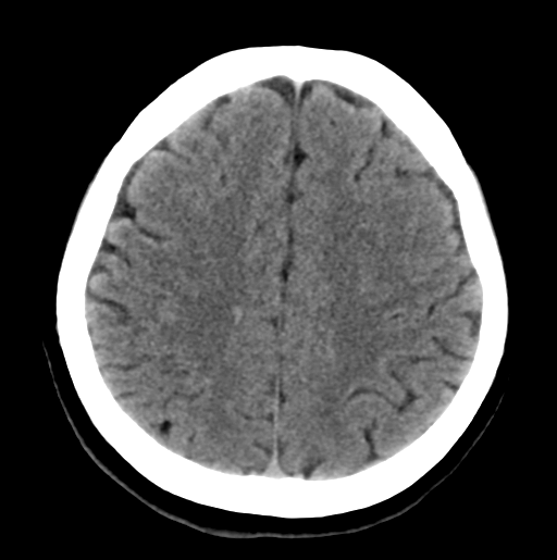 File:Cerebral cavernous venous malformations (Radiopaedia 48117-52945 Axial non-contrast 24).png