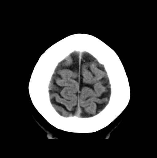 File:Cerebral cavernous venous malformations (Radiopaedia 48117-52945 Axial non-contrast 29).png