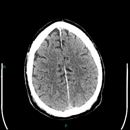 File:Cerebral contusions (Radiopaedia 33868-35039 Axial non-contrast 161).jpg