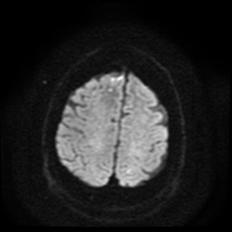 Cerebral embolic infarcts (embolic shower) (Radiopaedia 49837-55108 Axial DWI 58).jpg