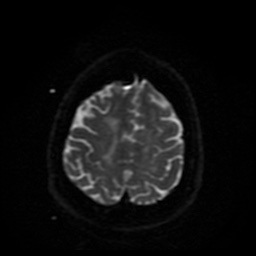 Cerebral embolic infarcts (embolic shower) (Radiopaedia 49837-55108 Axial DWI 9).jpg