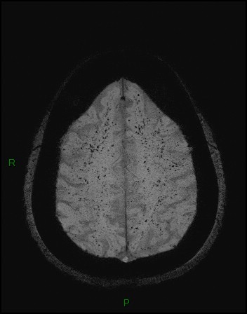 Cerebral fat embolism (Radiopaedia 35022-36525 Axial SWI 46).jpg