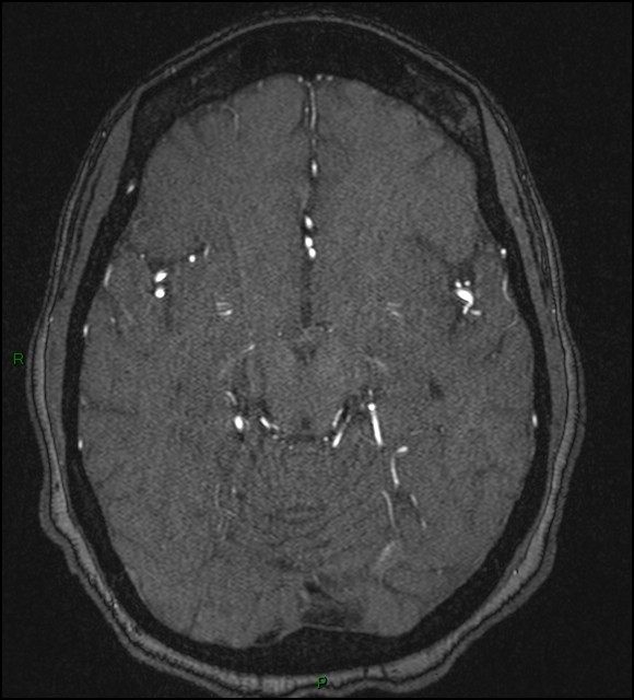 Cerebral fat embolism (Radiopaedia 35022-36525 Axial TOF 85).jpg