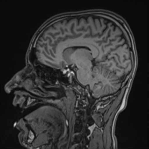 Cerebral fat embolism (Radiopaedia 57697-64639 Sagittal T1 29).png