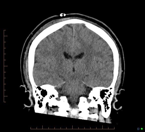 Cerebral fat embolism (Radiopaedia 85521-101224 Coronal non-contrast 37).jpg