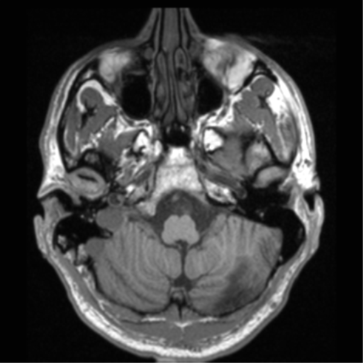 File:Cerebral hemorrhagic contusions- temporal evolution (Radiopaedia 40224-42757 Axial T1 15).png