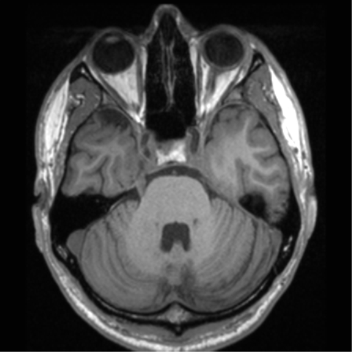 Cerebral hemorrhagic contusions- temporal evolution (Radiopaedia 40224-42757 Axial T1 23).png