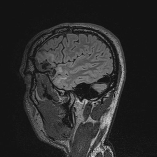 File:Cerebral hemorrhagic contusions- temporal evolution (Radiopaedia 40224-42757 Sagittal T1 66).png