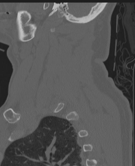 Cerebral hemorrhagic contusions and cervical spine fractures (Radiopaedia 32865-33841 Sagittal bone window 80).jpg