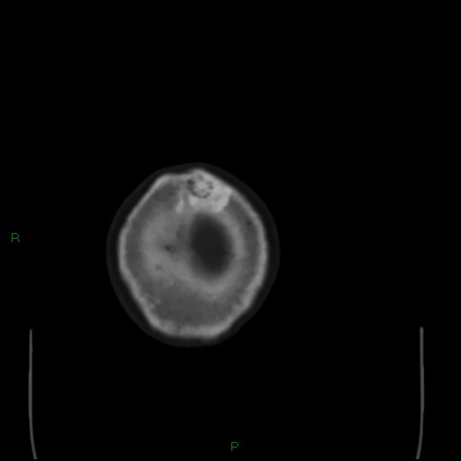 Cerebral metastases - breast primary (Radiopaedia 77653-89857 Axial bone window 113).jpg