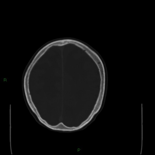 File:Cerebral metastases - breast primary (Radiopaedia 77653-89857 Axial bone window 88).jpg