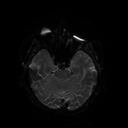 Cerebral metastases - melanoma (Radiopaedia 80972-94522 Axial DWI 75).jpg