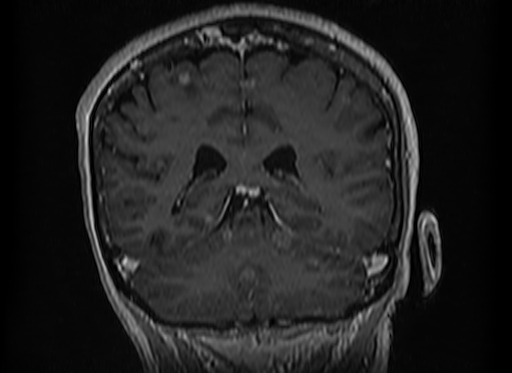 Cerebral metastases from lung cancer with amyloid angiopathy and cerebellopontine angle meningioma (Radiopaedia 74306-85191 Coronal T1 C+ 41).jpg
