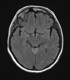 File:Cerebral metastases mimicking abscesses (Radiopaedia 45841-50131 Axial FLAIR 13).png