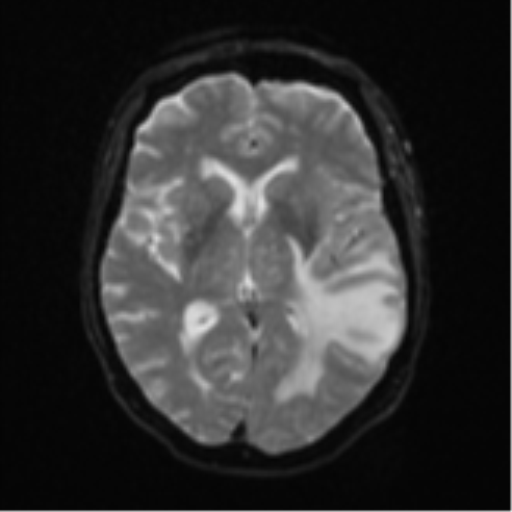 Cerebral metastasis (Radiopaedia 46744-51248 Axial DWI 14).png