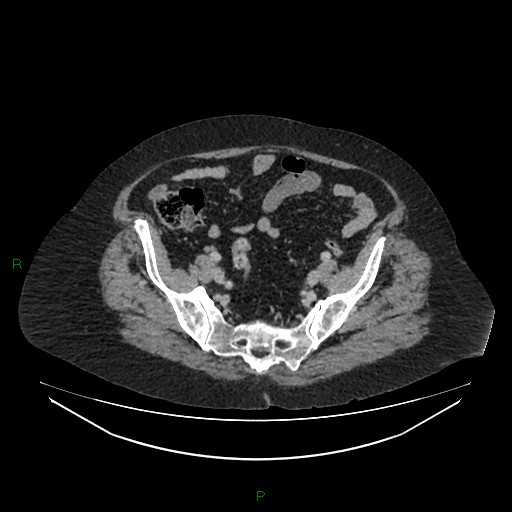 Cerebral metastasis from renal cell carcinoma (Radiopaedia 82306-96378 A 148).jpg