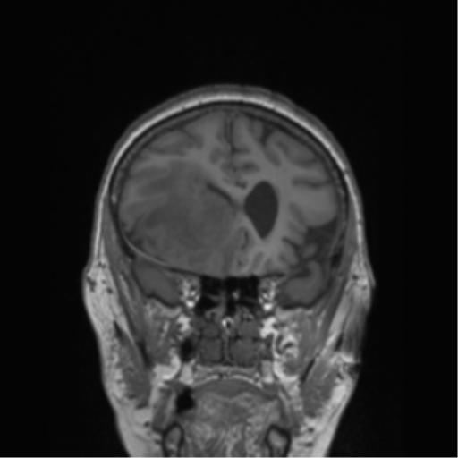 Cerebral metastasis to basal ganglia (Radiopaedia 81568-95413 Coronal T1 44).png