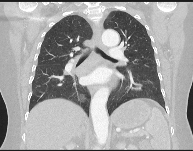 Cerebral metastasis to basal ganglia (Radiopaedia 81568-95414 Coronal lung window 51).png