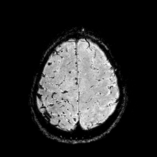 Cerebral parenchymal arteriovenous malformation (Radiopaedia 27280-27456 Axial SWI 103).jpg