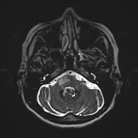 Cerebral ring enhancing lesions - cerebral metastases (Radiopaedia 44922-48817 F 27).jpg