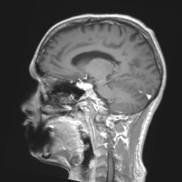 File:Cerebral toxoplasmosis (Radiopaedia 53993-61435 Coronal T1 15).jpg