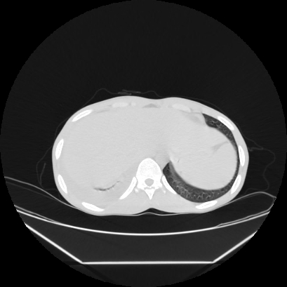 Cerebral tuberculoma (Radiopaedia 80829-94318 Axial lung window 169).jpg