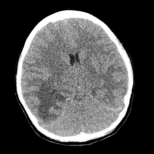 Cerebral tuberculosis with dural sinus invasion (Radiopaedia 60353-68018 Axial non-contrast 27).jpg