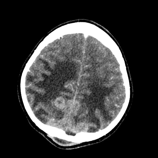 Cerebral tuberculosis with dural sinus invasion (Radiopaedia 60353-68019 Axial C+ delayed 51).jpg