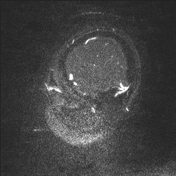 Cerebral tuberculosis with dural sinus invasion (Radiopaedia 60353-68090 Sagittal MRV 138).jpg