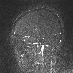 Cerebral tuberculosis with dural sinus invasion (Radiopaedia 60353-68090 Sagittal MRV 36).jpg