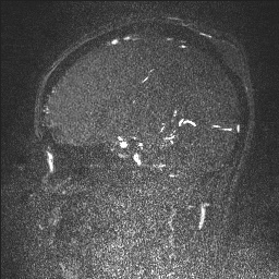 Cerebral tuberculosis with dural sinus invasion (Radiopaedia 60353-68090 Sagittal MRV 63).jpg