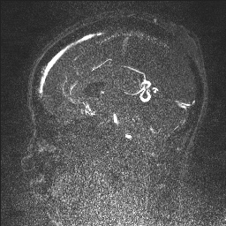 Cerebral tuberculosis with dural sinus invasion (Radiopaedia 60353-68090 Sagittal MRV 75).jpg