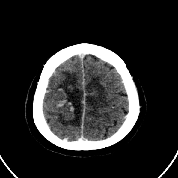 File:Cerebral venous hemorrhagic infarct from venous sinus thrombosis (Radiopaedia 55433-61883 Axial C+ delayed 28).jpg