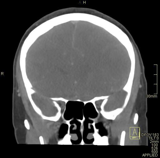 Cerebral venous sinus thrombosis (Radiopaedia 91329-108965 Coronal venogram 30).jpg