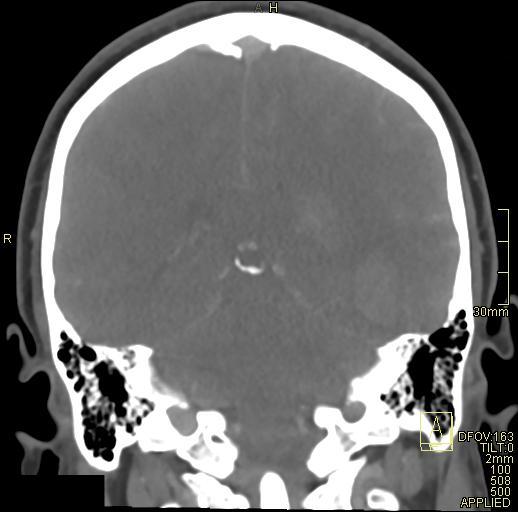 Cerebral venous sinus thrombosis (Radiopaedia 91329-108965 Coronal venogram 57).jpg