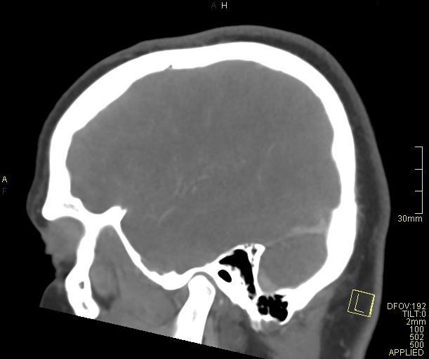 Cerebral venous sinus thrombosis (Radiopaedia 91329-108965 Sagittal venogram 17).jpg