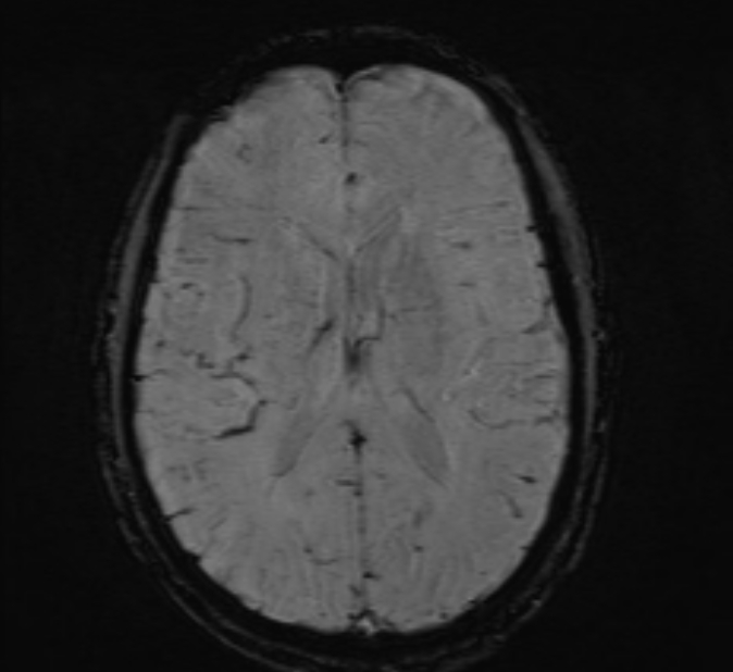 Cerebral venous thrombosis (Radiopaedia 71207-81504 Axial SWI 31).jpg
