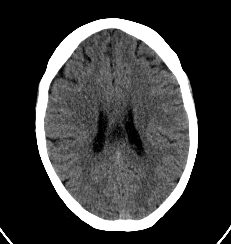 Cerebral venous thrombosis - CT only (Radiopaedia 41031-43778 Axial non-contrast 31).jpg