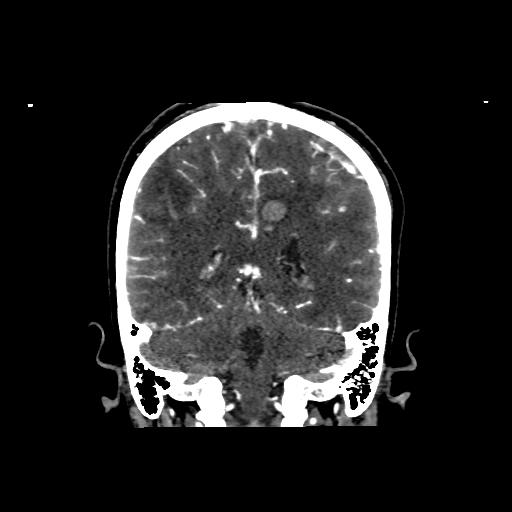 File:Cerebral venous thrombosis - hemorrhagic venous infarction (Radiopaedia 87318-103613 Coronal 10).jpg