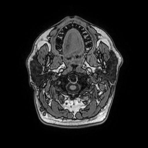 File:Cerebral venous thrombosis with secondary intracranial hypertension (Radiopaedia 89842-106957 Axial T1 21).jpg