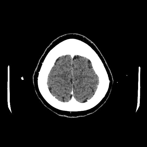 Cerebral venous thrombosis with venous hemorrhagic infarct (Radiopaedia 90354-107660 Axial with contrast 148).jpg