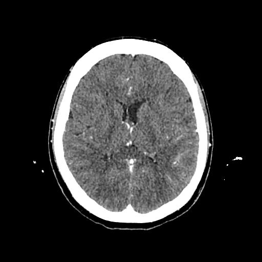 Cerebral venous thrombosis with venous hemorrhagic infarct (Radiopaedia 90354-107660 Axial with contrast 95).jpg