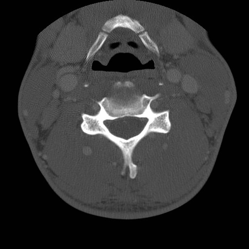 Cervical Pott disease (Radiopaedia 20374-20286 Axial bone window 79).jpg