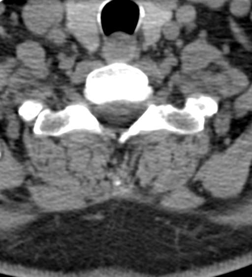 File:Cervical canal stenosis - OPLL and osteophytes (Radiopaedia 47329-51910 Axial non-contrast 50).png