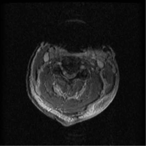 Cervical canal stenosis with cord compression (Radiopaedia 34114-35374 Axial Gradient Echo 62).png