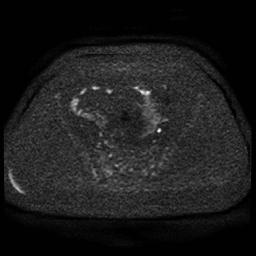 Cervical carcinoma (Radiopaedia 85405-101028 Axial DWI 76).jpg