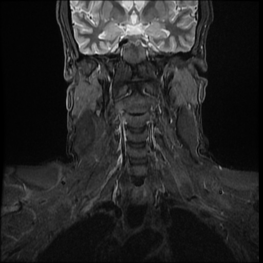 File:Cervical disc extrusion (Radiopaedia 59074-66364 Coronal STIR 3).jpg