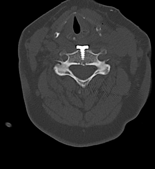 File:Cervical spine ACDF loosening (Radiopaedia 48998-54070 Axial bone window 34).png
