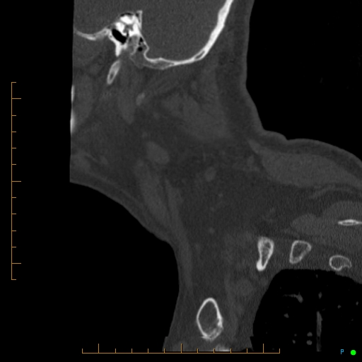 Cervical spine fracture - ankylosing spondylitis (Radiopaedia 76835-88706 Sagittal bone window 103).jpg