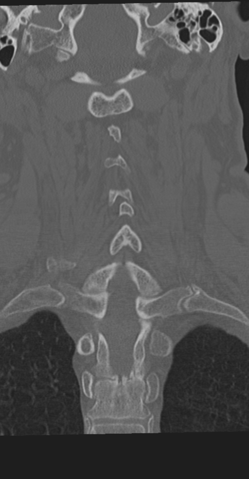 Cervical spine fracture in the setting of ankylosis (Radiopaedia 37038-38715 Coronal bone window 46).png